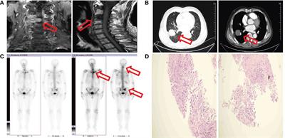 Acute urinary retention due to corpus cavernosum penile metastasis from lung adenocarcinoma after targeted therapy: a case report and review of the literature